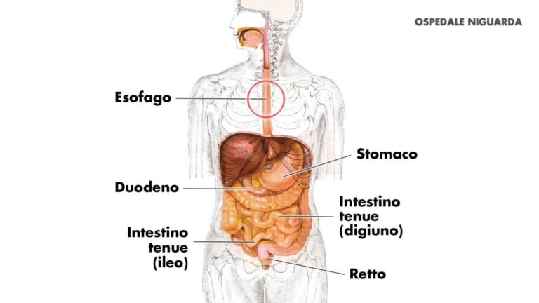 Legatura delle Varici Esofagee: Tecniche e Benefici
