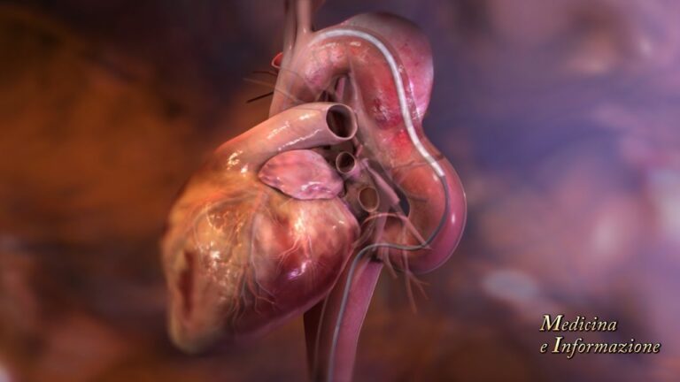Comprendere l’Aneurisma Cardiaco: Cause, Sintomi e Trattamenti