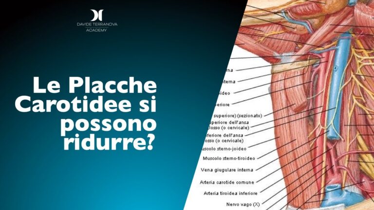 Comprendere le placche carotidee: cause, effetti e prevenzione