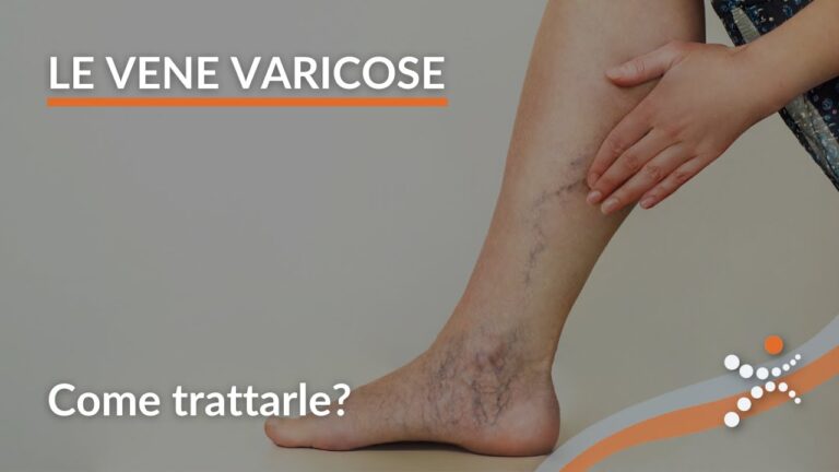 Comprendere e Trattare le Varici agli Arti Inferiori